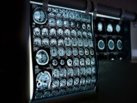 Na czym polega neurologia?